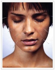 NYC Bell's Palsy Acupuncture