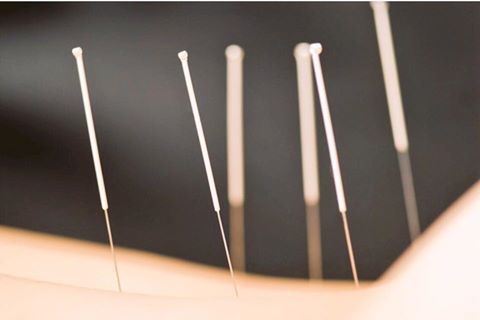PCOS Acupuncture in NYC