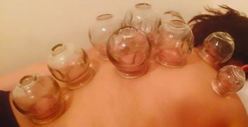Cupping Therapy NYC