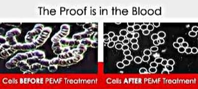 Before and After cells with PEMF in NYC